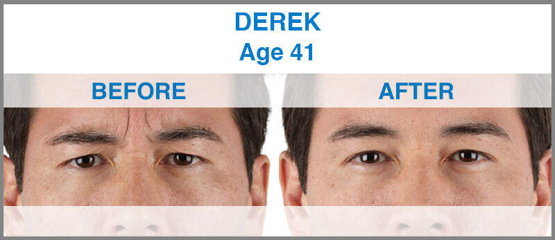 Before and After Image: Xeomin - front