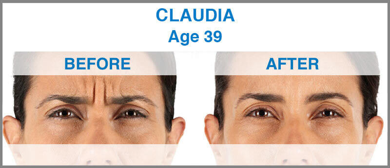 Before and After Image: Xeomin - front
