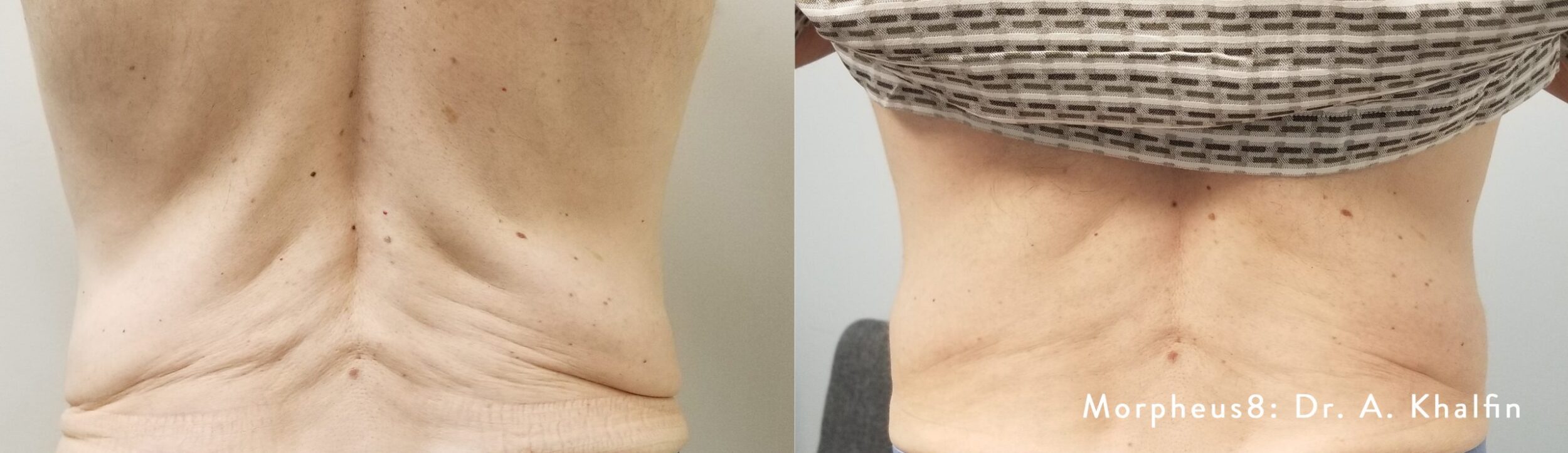 Before and After Image: Tightening & Debulking - back
