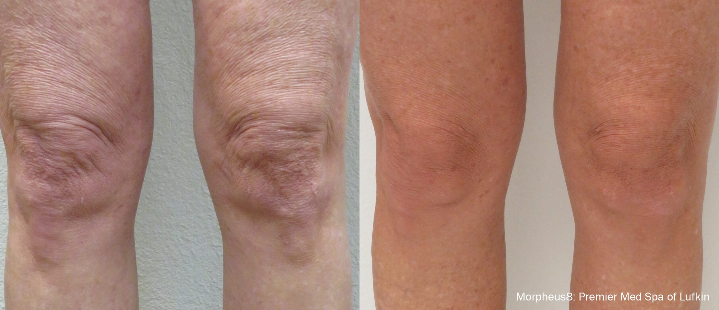 Before and After Image: Tightening & Debulking - front