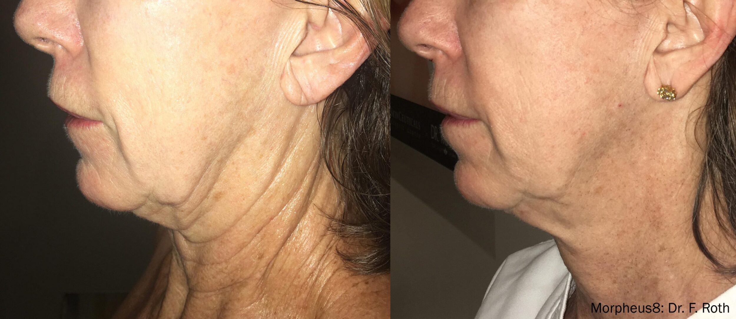 Before and After Image: Tightening & Debulking - left-side