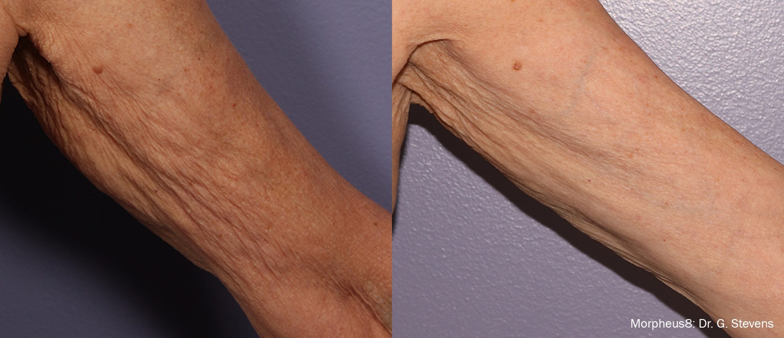 Before and After Image: Tightening & Debulking - front
