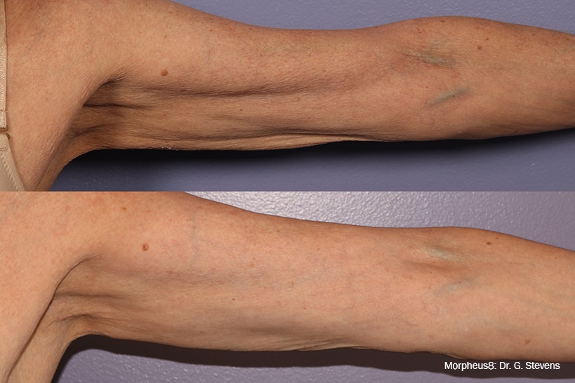Before and After Image: Tightening & Debulking - front