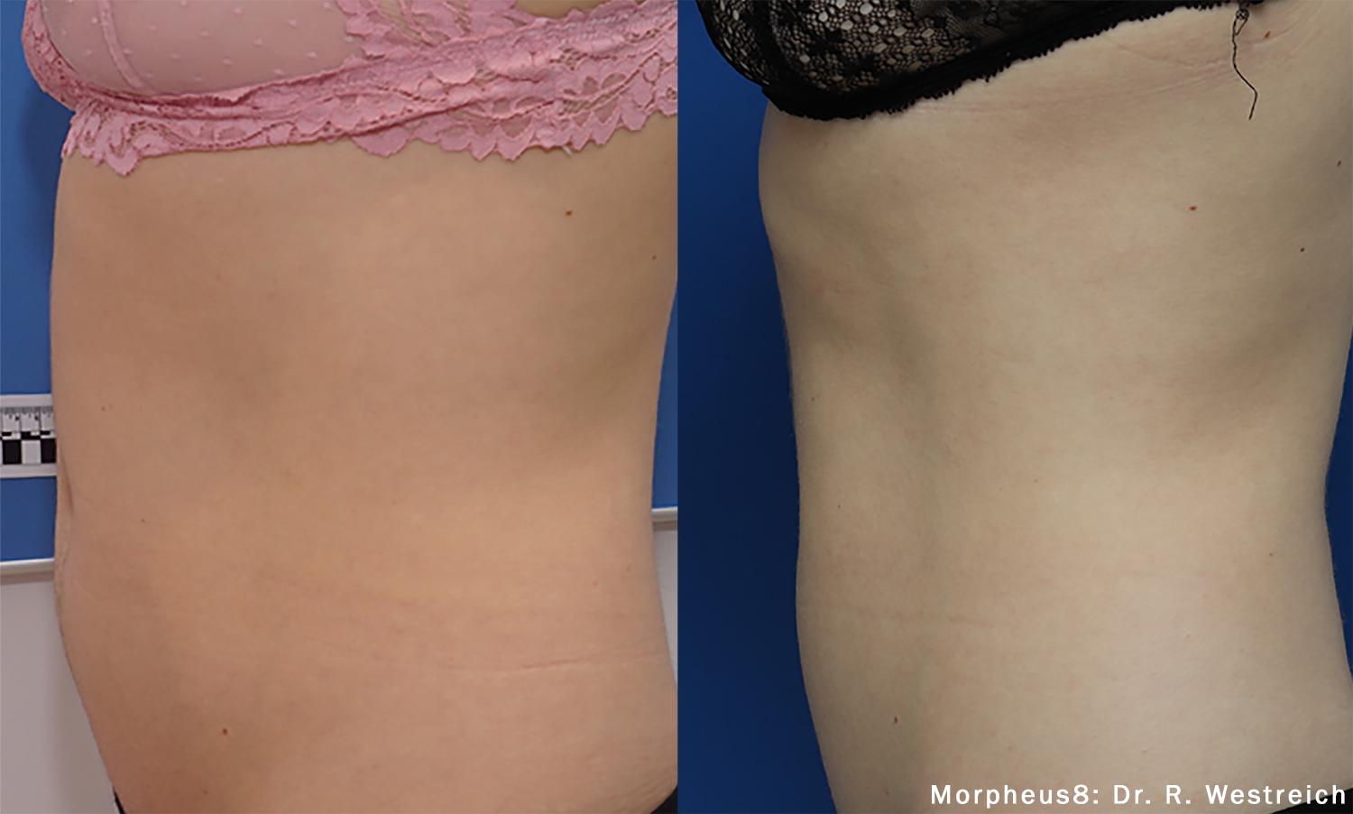 Before and After Image: Tightening & Debulking - left-side