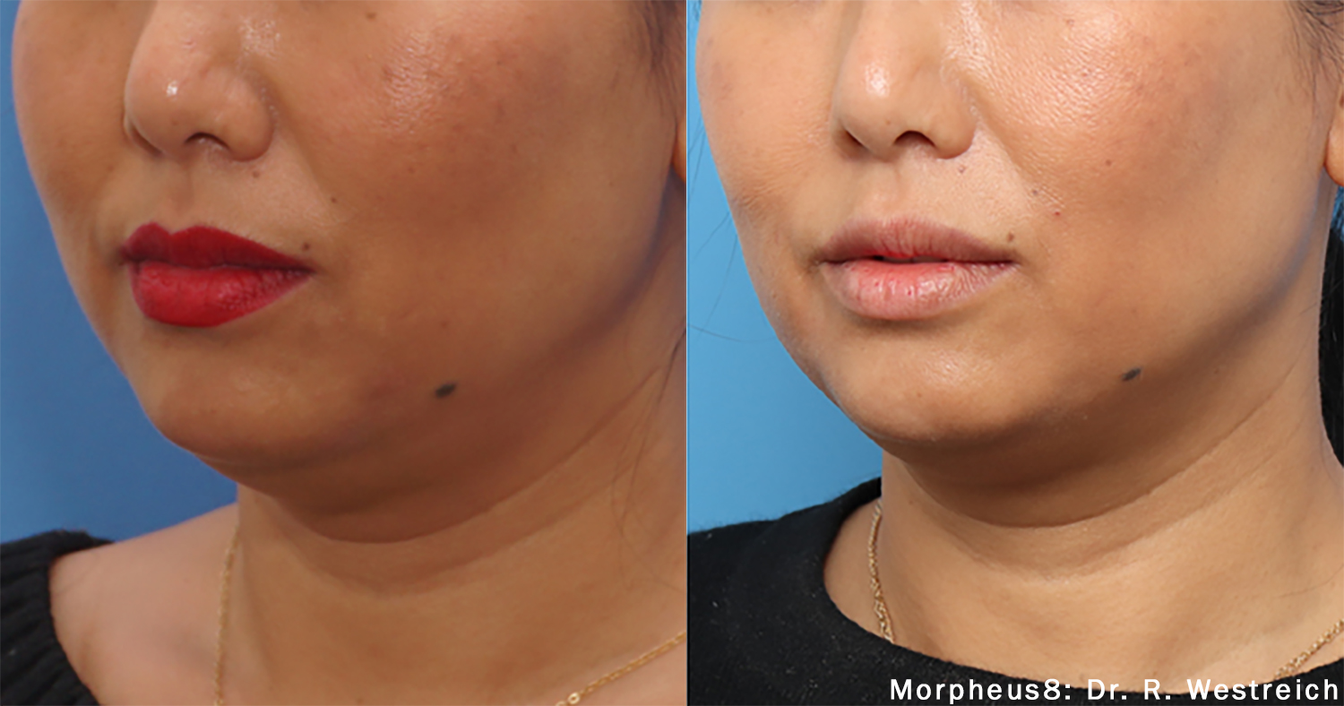 Before and After Image: Tightening & Debulking - left-front-oblique