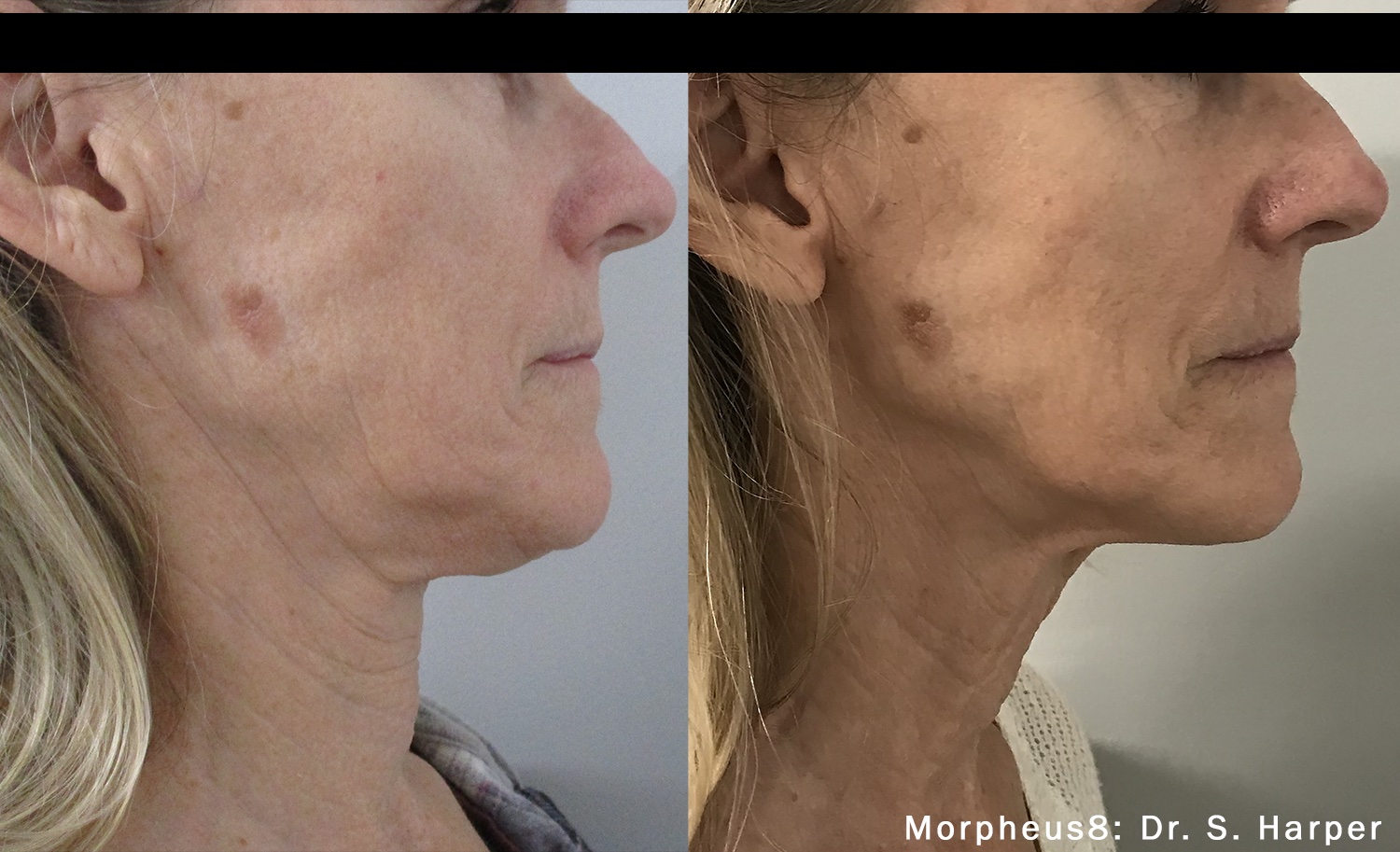 Before and After Image: Tightening & Debulking - right-side