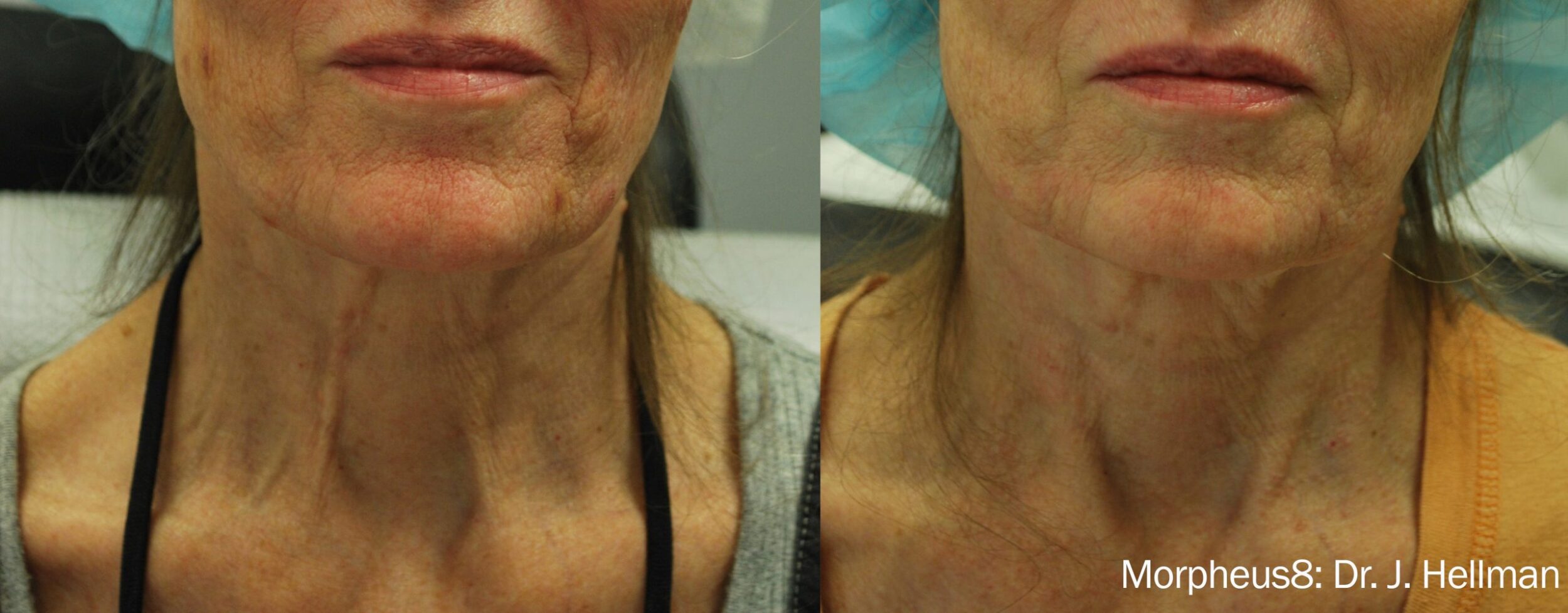 Before and After Image: Tightening & Debulking - front