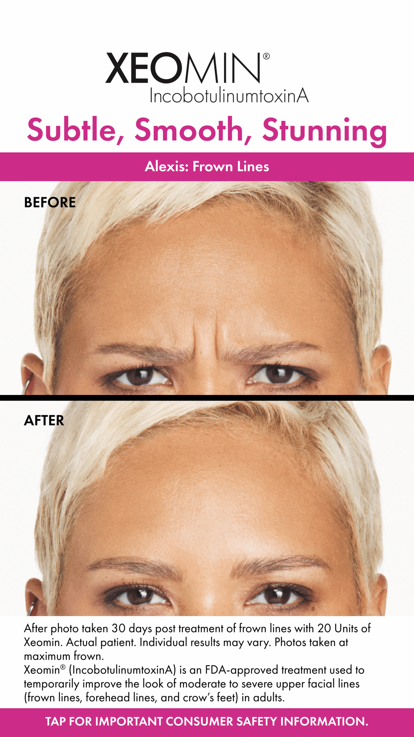 Before and After Image: Xeomin - front