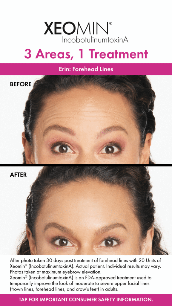 Before and After Image: Xeomin - front
