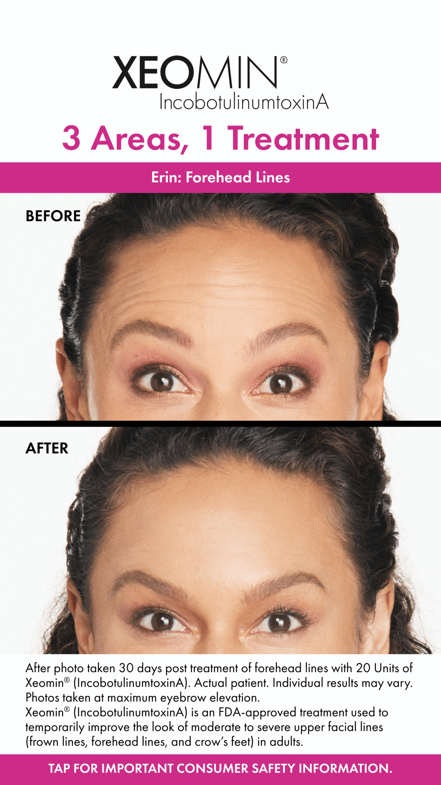 Before and After Image: Xeomin - front