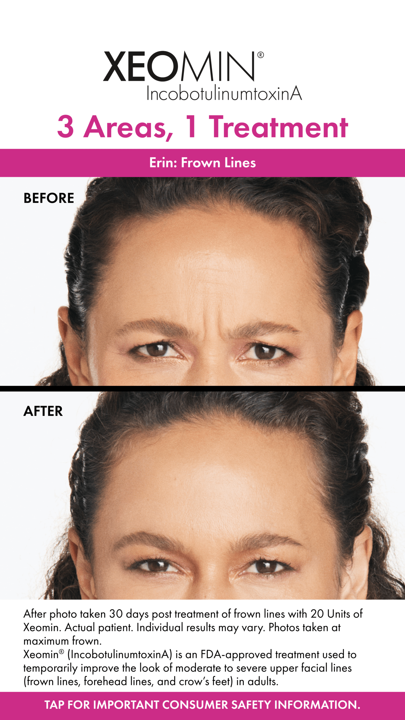 Before and After Image: Xeomin - front