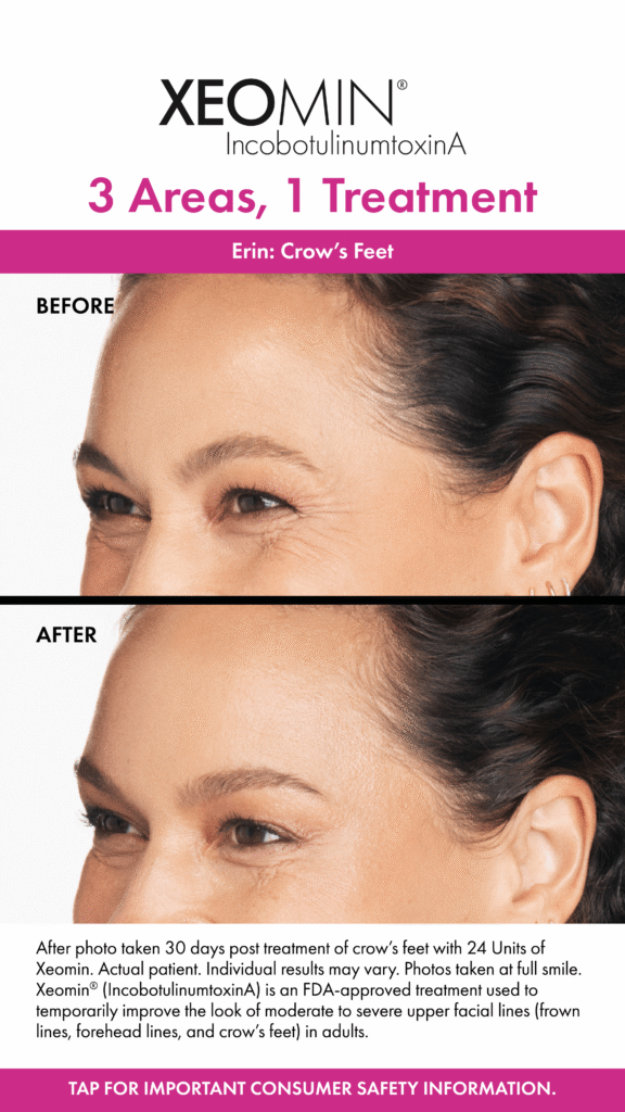 Before and After Image: Xeomin - left-front-oblique