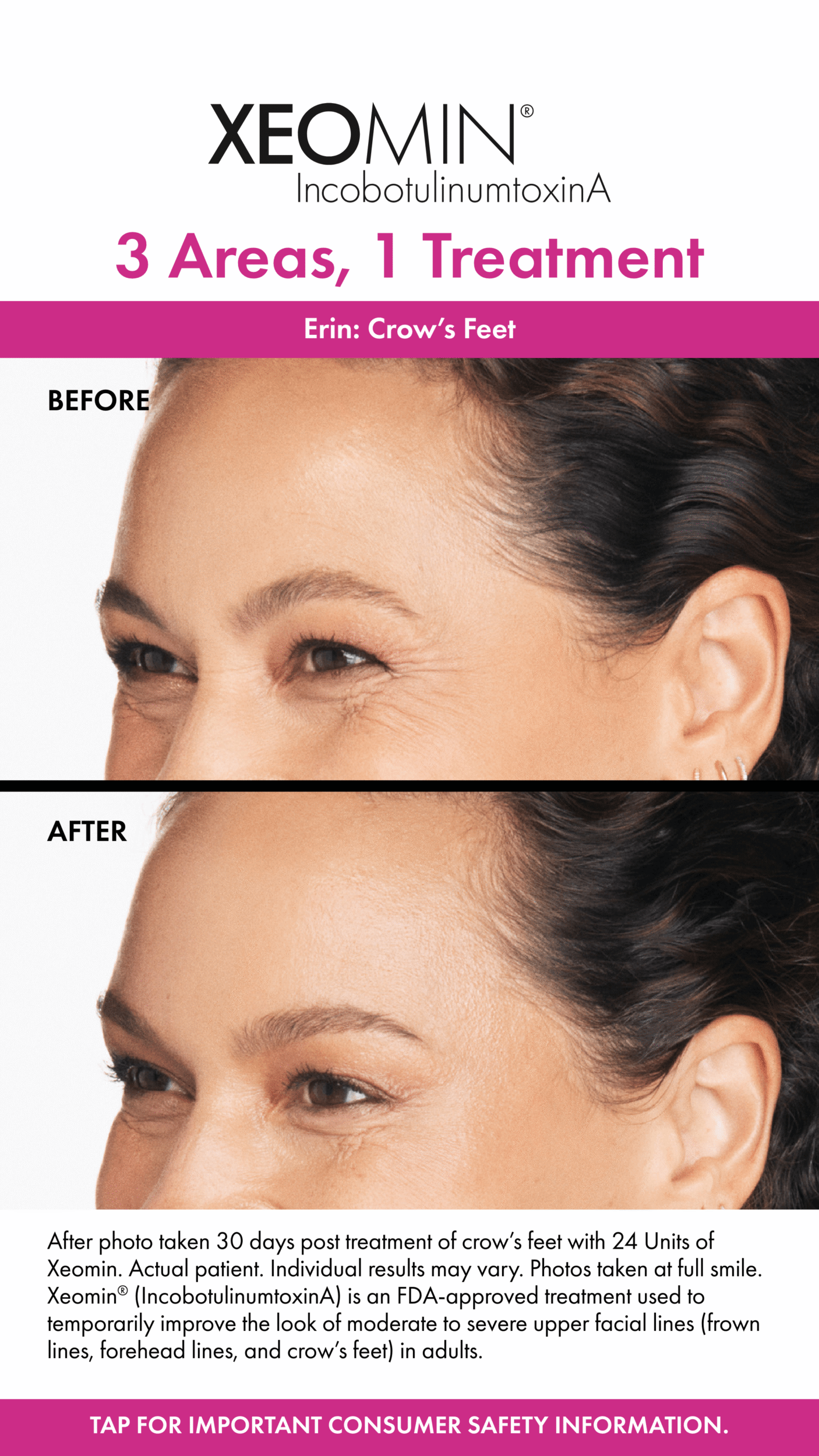 Before and After Image: Xeomin - left-front-oblique