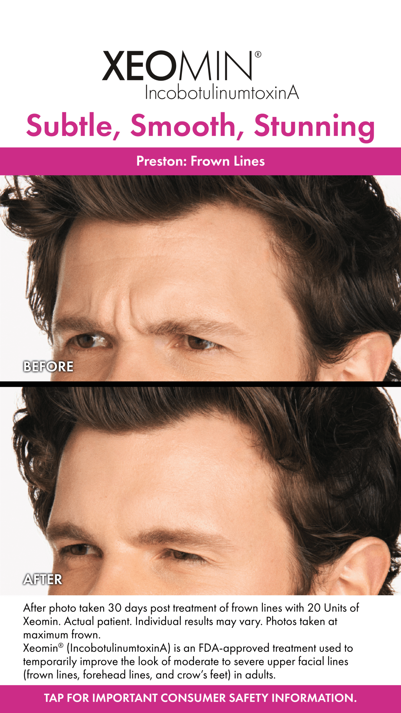 Before and After Image: Xeomin - left-front-oblique
