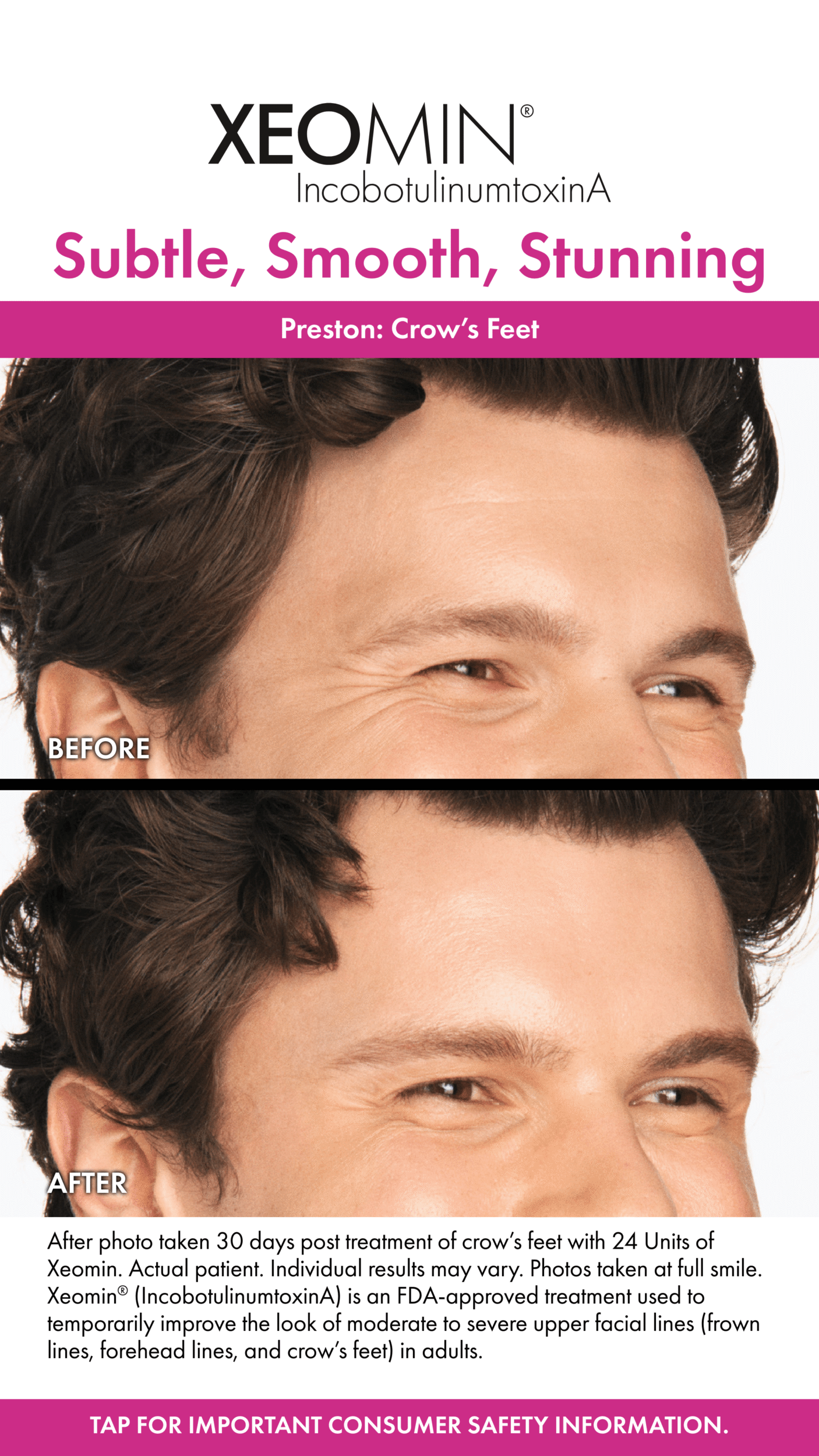 Before and After Image: Xeomin - right-front-oblique