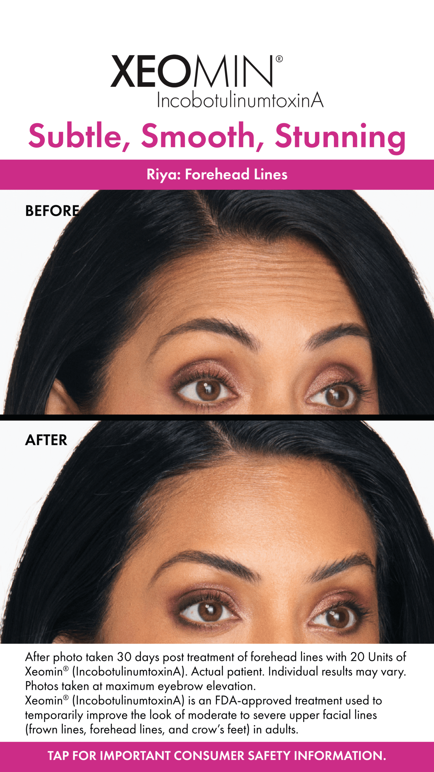 Before and After Image: Xeomin - right-front-oblique