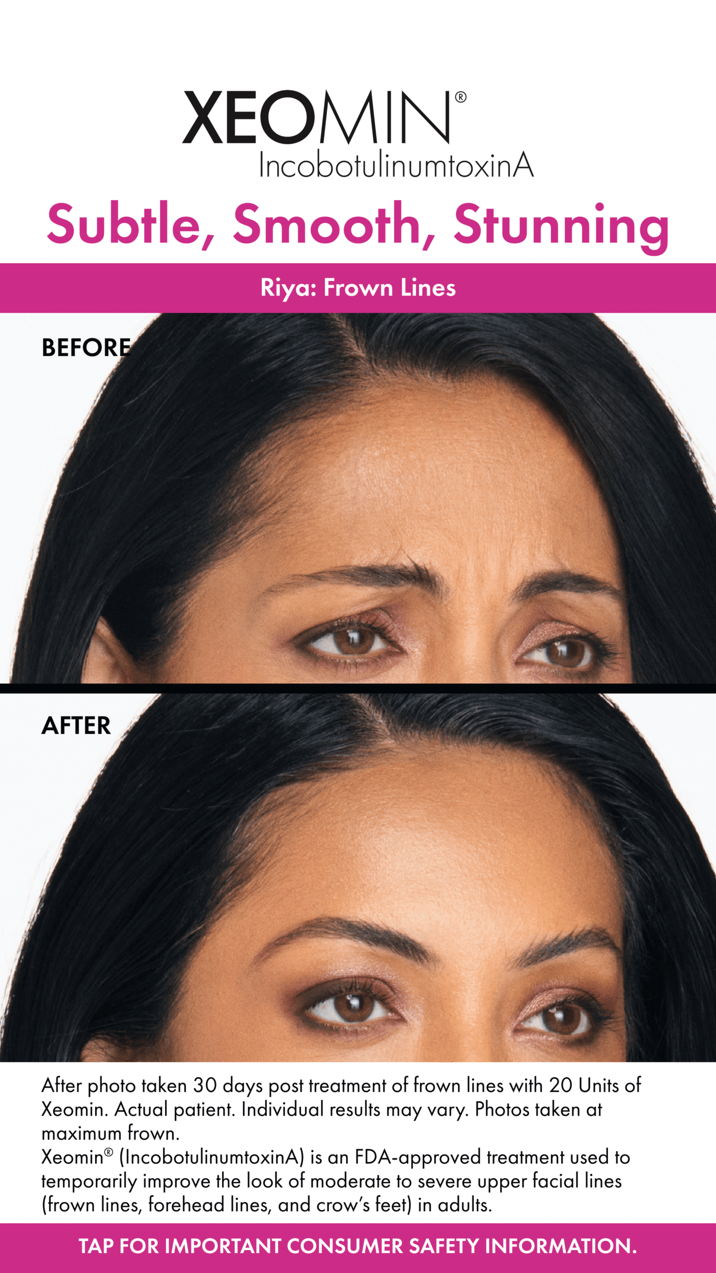 Before and After Image: Xeomin - right-front-oblique