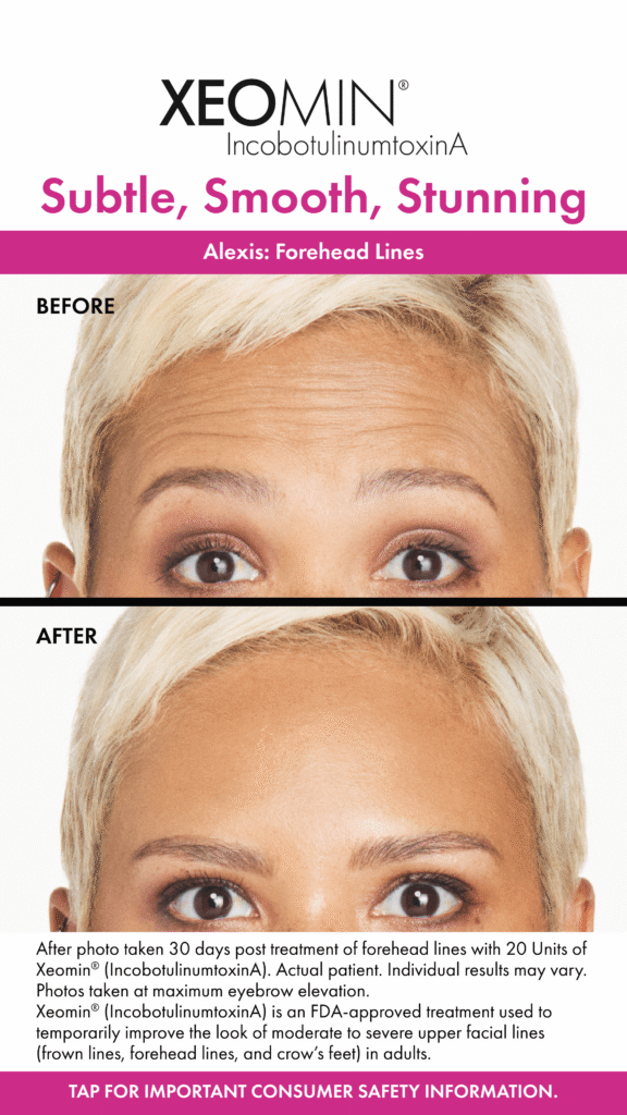 Before and After Image: Xeomin - front
